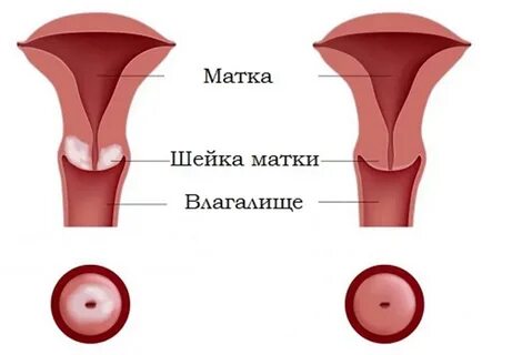 Воспаление цервикального канала шейки