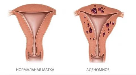 Эндометриоз после месячных
