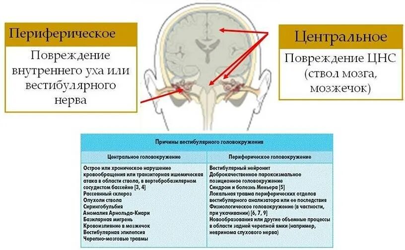 Почему появляется головокружение. Вестибулярные расстройства. Периферическое вестибулярное головокружение. Головокружение причины. Периферическое головокружение причины.