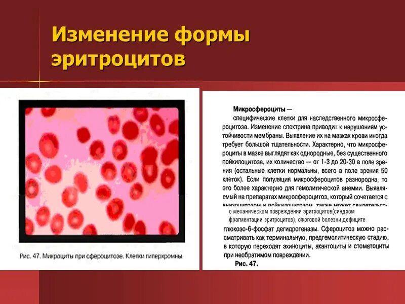 Эритроциты форма постоянная. Клиника в12 дефицитной анемии. пойкилоцитоз апластическая анемия. апластическая анемия эритроциты форма. изменение формы эритроцитов.