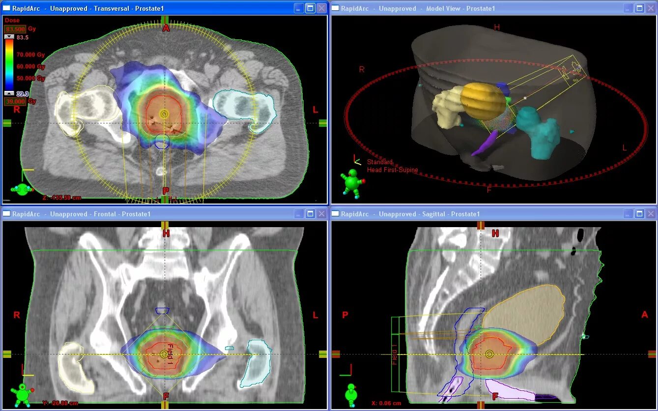 Трехмерное планирование лучевой терапии. IMRT лучевая терапия. Оконтуривание в лучевой терапии. Трехмерная конформная лучевая терапия. Онкология простаты лучевая