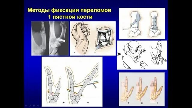 Мкб 10 закрытый перелом пястных костей. Мкб 10 закрытый перелом пястных костей