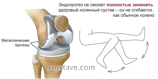 Эндопротезирование связок коленного сустава. Велотренажер после эндопротезирования коленного сустава. Эндопротезирование тазобедренного сустава шов. Физкультура после эндопротезирования коленного сустава.
