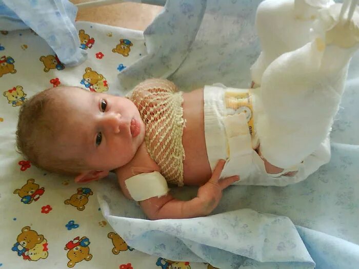 переломы у новорожденных детей. поднадкостничный перелом ключицы новорожденного. родовая травма перелом ключицы новорожденного. перелом ключицы у новорожденных. родовая травма перелом ключицы.