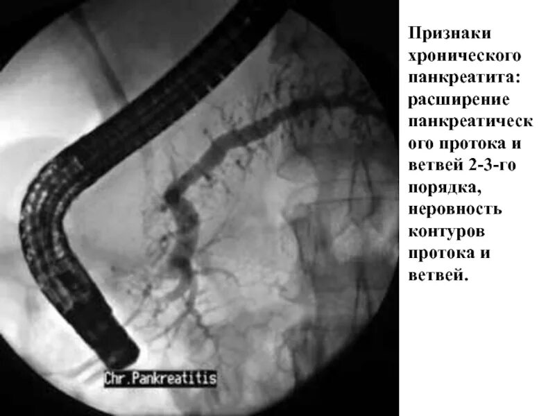 Хронический панкреатит ЭРХПГ. Холангиопанкреатография поджелудочной железы. Стентирование желчного протока. Эндоскопическое стентирование желчного протока. Стент желчного протока