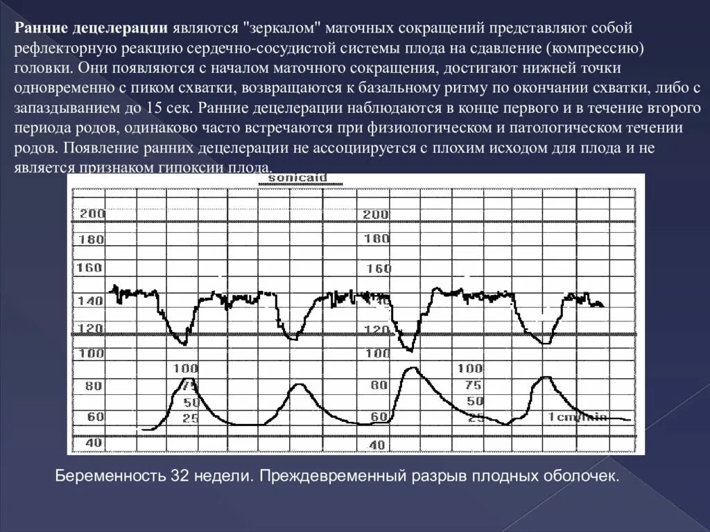 Исследование сердцебиения плода. Патологический Тип КТГ плода. Ранние децелерации. Децелерации на КТГ.