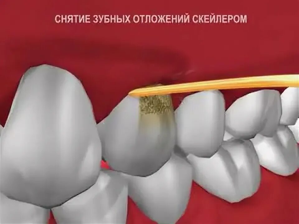 Скалинг гель для удаления зубных. После ультразвука на зубе бугор. g2 удаление твёрдых зубных отложений. работа скейлером в полости рта.