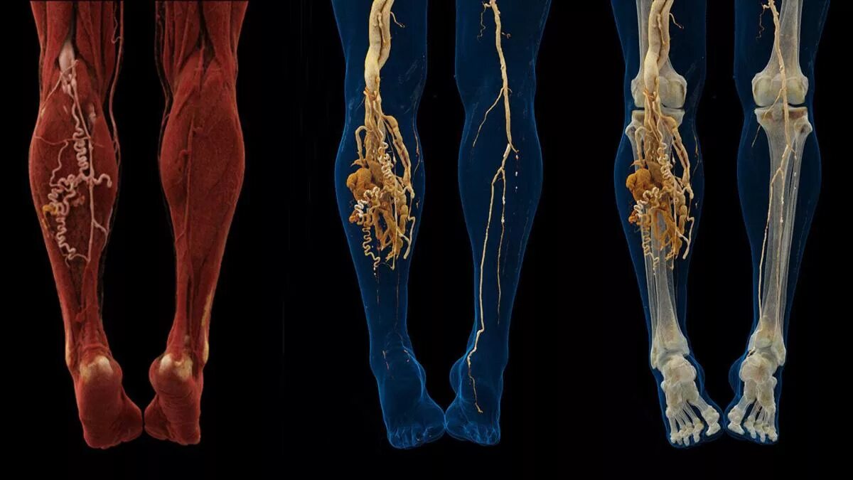 И сосудов нижних конечностей цена. Кт-ангиография артерий нижних конечностей. Кт ангиография сосудов нижних конечностей. Тромбоз артерий нижних конечностей кт. Тромбоз нижних конечностей ангиография.