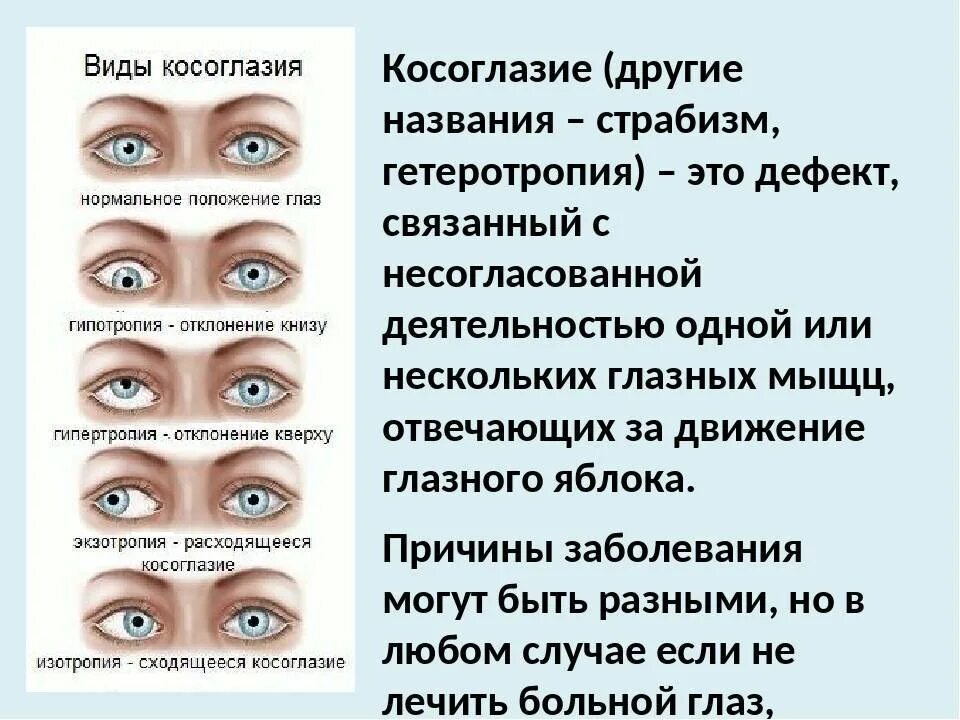 Зрение в 1 месяц. Косоглазие. Виды косоглазия. Болезни глаз косоглазие. Эзотропия сходящееся косоглазие.