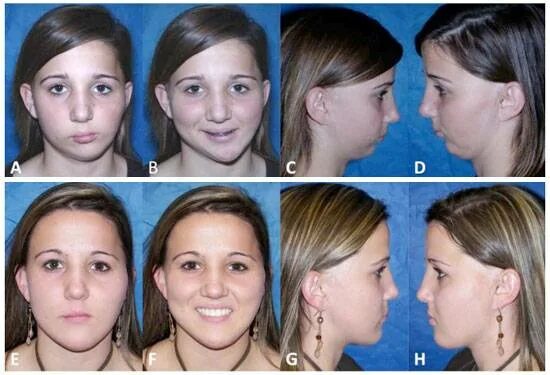 Кронштейн заднего амортизатора нива шевроле. Расчет забойного давления в скважине формула. Удлинить нижний рычаг ваз классика 2107. Удлинение верхнего. М.