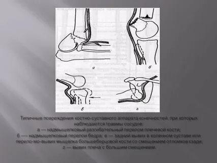 Повреждение бедренной артерии