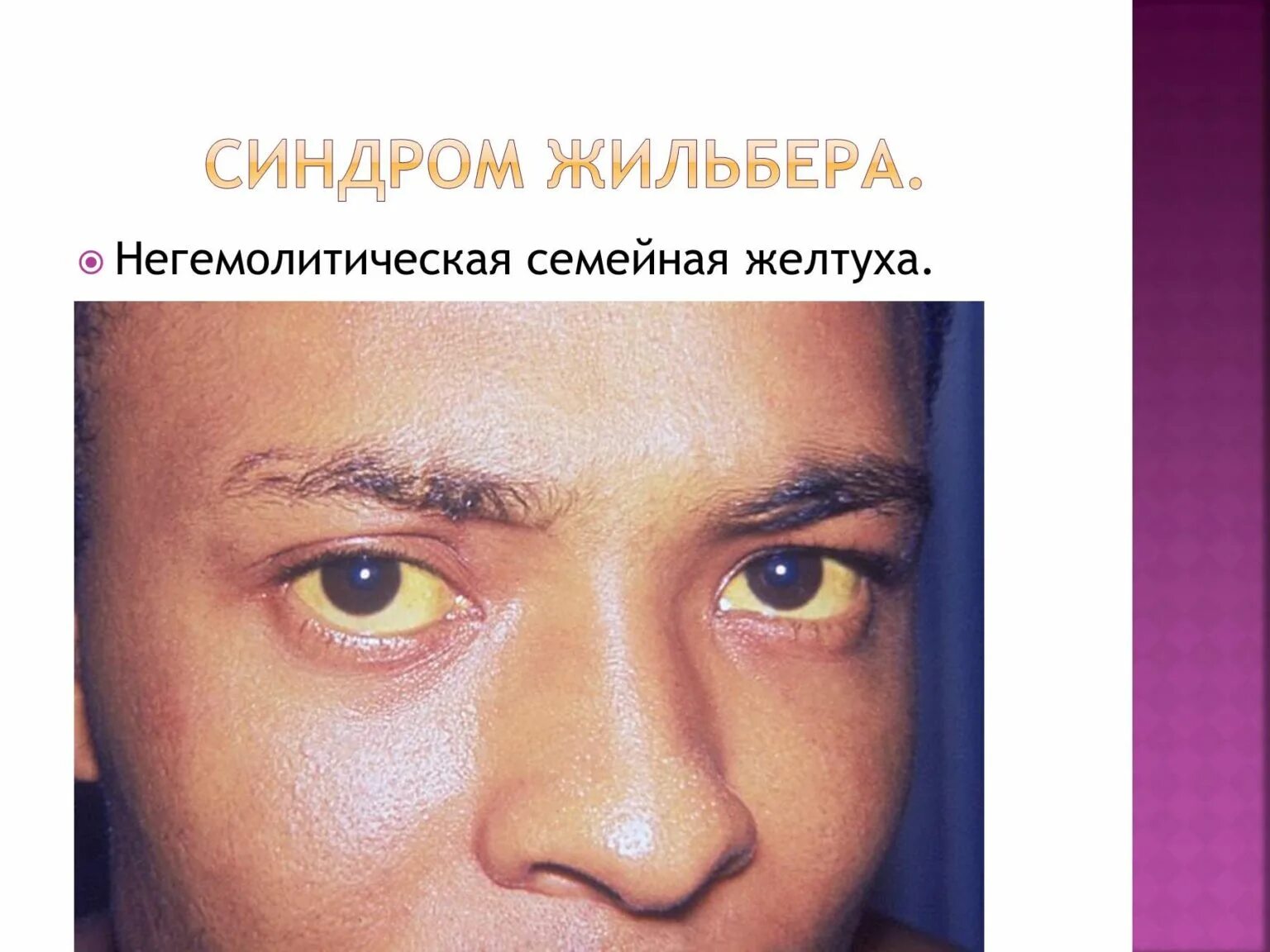 Диагноз синдром жильбера. Синдром жельбежельбера. болезнь синдром жильбера. синдром жильбера желтуха.