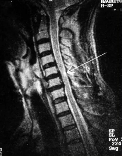 Грыжа 6 мм. Миелопатия с5-с6. Сагиттальный стеноз позвоночного канала с5-с7. Грыжа с5-с6 шейного отдела мрт. Спинальный стеноз с6-с7.