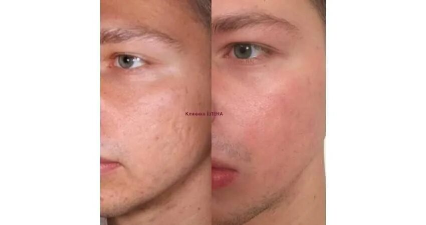 Rejuvasil силиконовый гель. Мазь от шрамов аналог контрактубекса. Фракционный фототермолиз со2 лазером. Креп от шрамоа. Нормотрофический рубец рубец.
