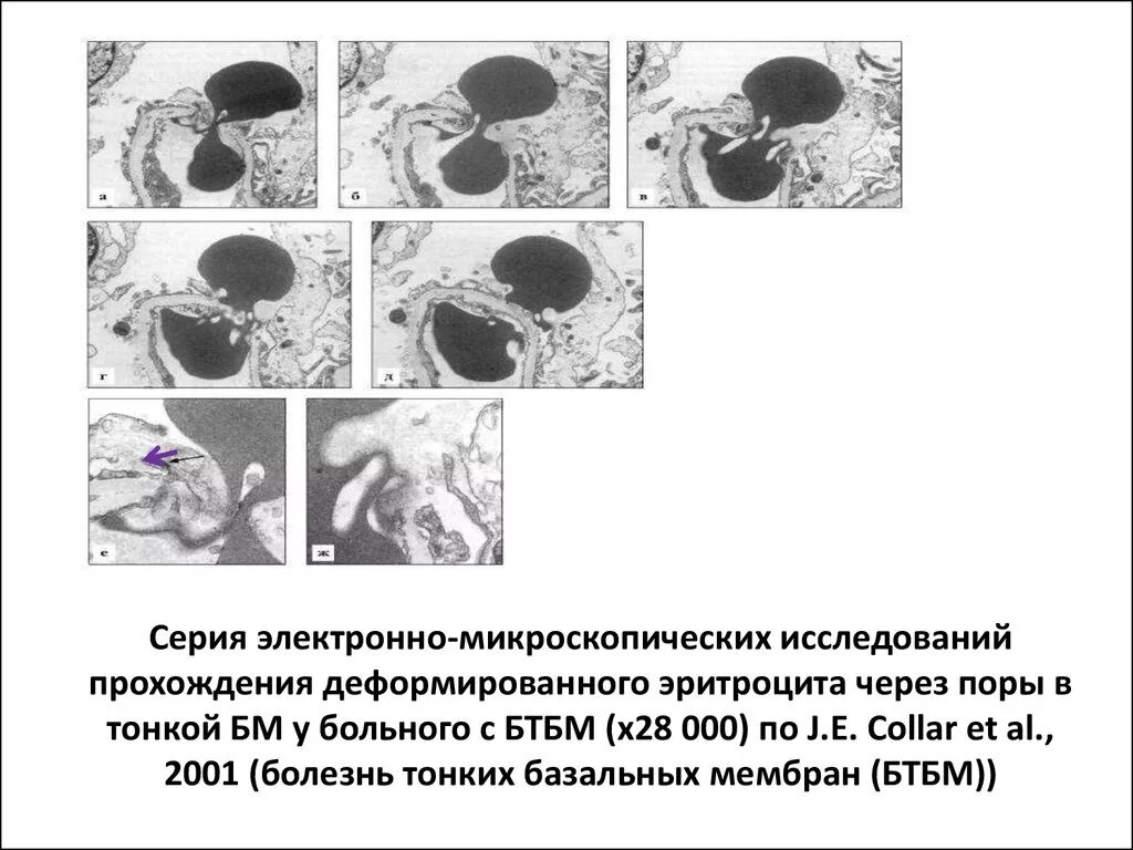 Болезнь тонких базальных мембран. Болезнь тонких базальных мембран. Болезнь тонких базальных мембран. Синдром альпорта тип наследования. Синдром альпорта электронная микроскопия.