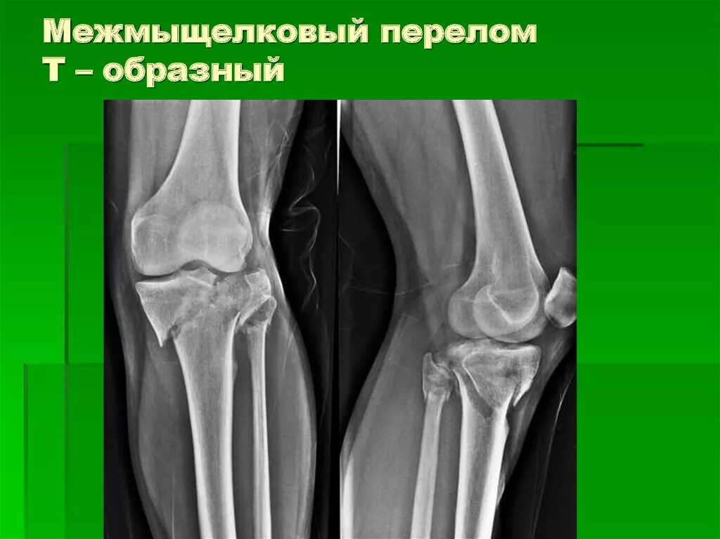 перелом берцовой кости коленного сустава