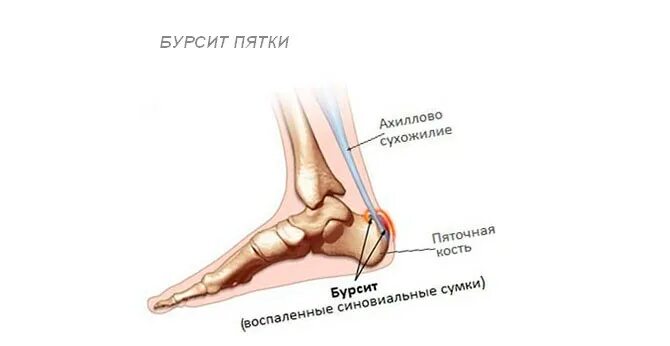 Болит пятка сбоку