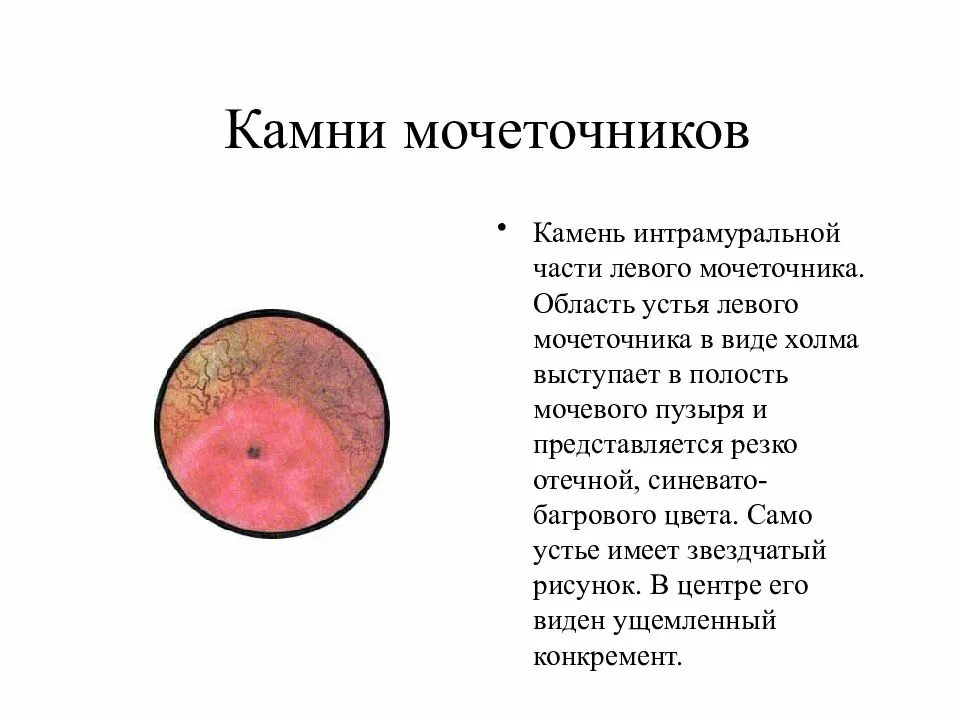 Интрамуральный мочеточник. Устью мочетонника камень. Конкремент устья мочеточника. Камень в Устье мочеточника 5 мм. Камень в мочеточнике Устье 6 мм.