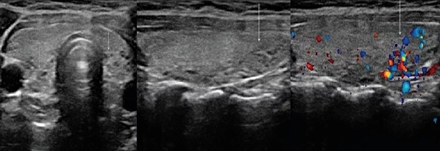Тиреоидит де Кервена УЗИ. Тиреоидит щитовидной железы на УЗИ. АИТ на УЗИ щитовидной железы. Диффузно инфильтративная