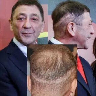 Лепс лишай