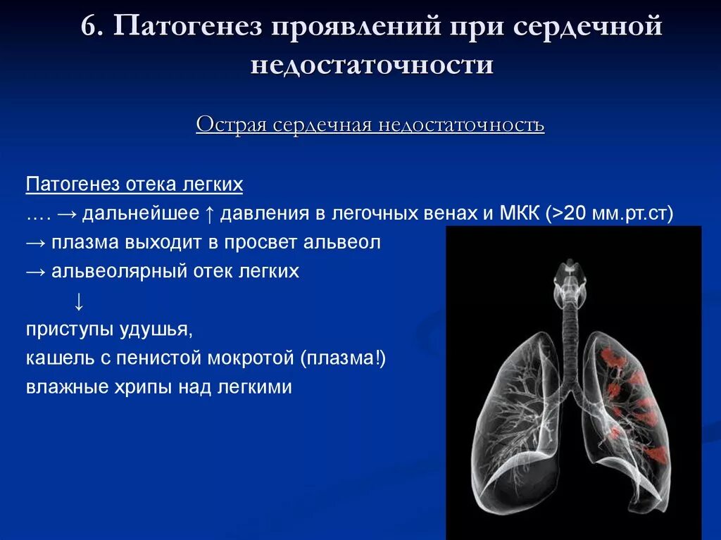 Признаки недостаточности легких. Механизм развития отёка легких при сердечной недостаточности. Отек легких патогенез патофизиология. Отёк лёгких при сердечной недостаточности патогенез. Альвеолярный отек легких патогенез.