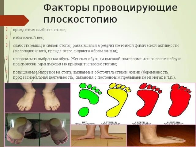 Стопа плоскостопие. Продольное и поперечное плоскостопие. Плоскостопие история болезни. Плоскостопие история болезни. Плоскостопие история болезни.