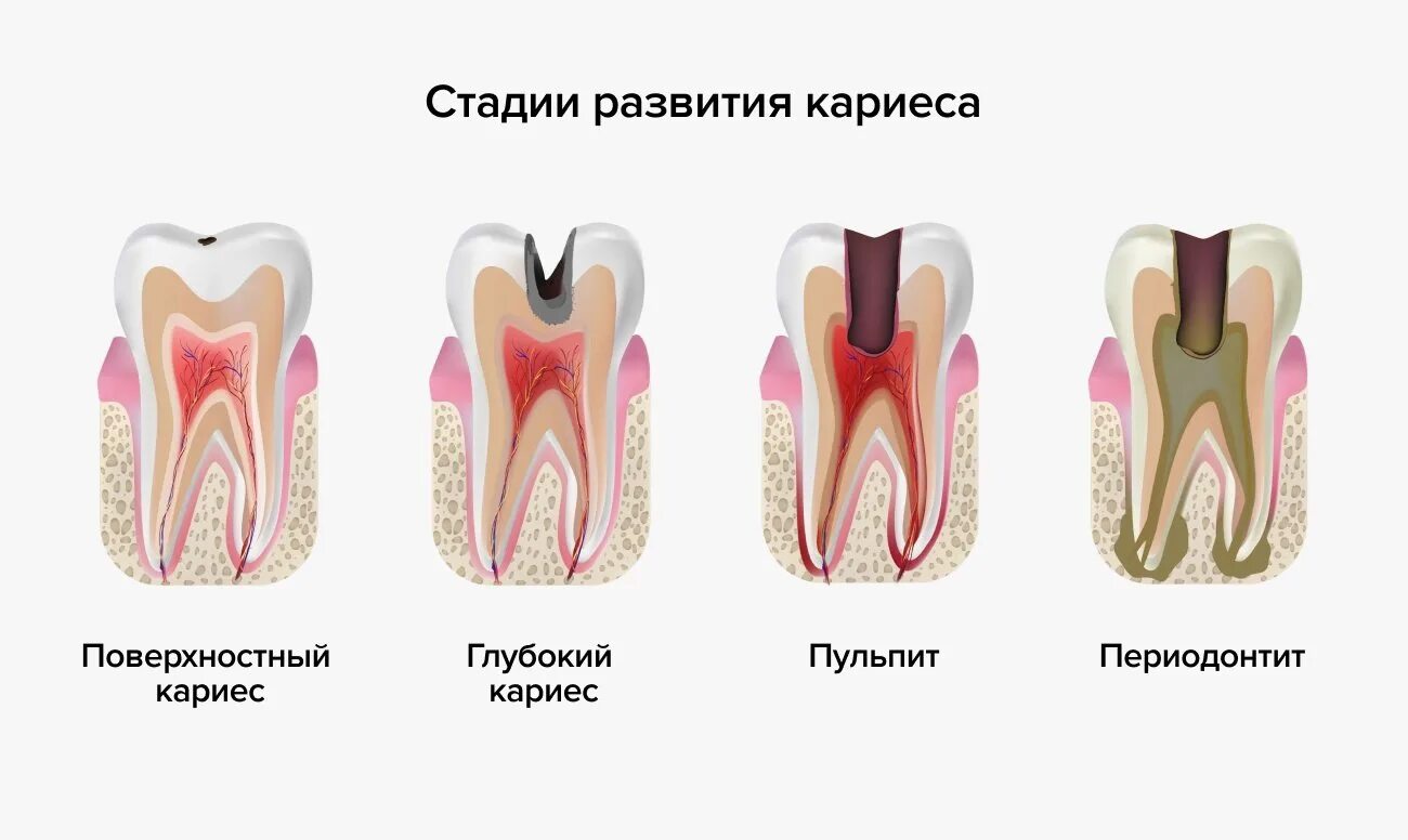 Болят зубы с правой стороны. Кариес пульпит периодонтит. Зубы кариес пульпит периодонтит. Острый серозный периодонтит. Острый Гнойный периодонтит патогенез.
