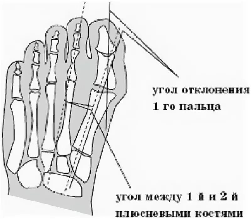 Угол пальца. Угол между 1 и 2 плюсневыми костями норма. поперечное плоскостопие рентген степени. угол между 1 и 5 плюсневыми костями норма. угол между осями 1 и 5 плюсневых костей.
