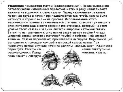 Манчестерская операция в гинекологии