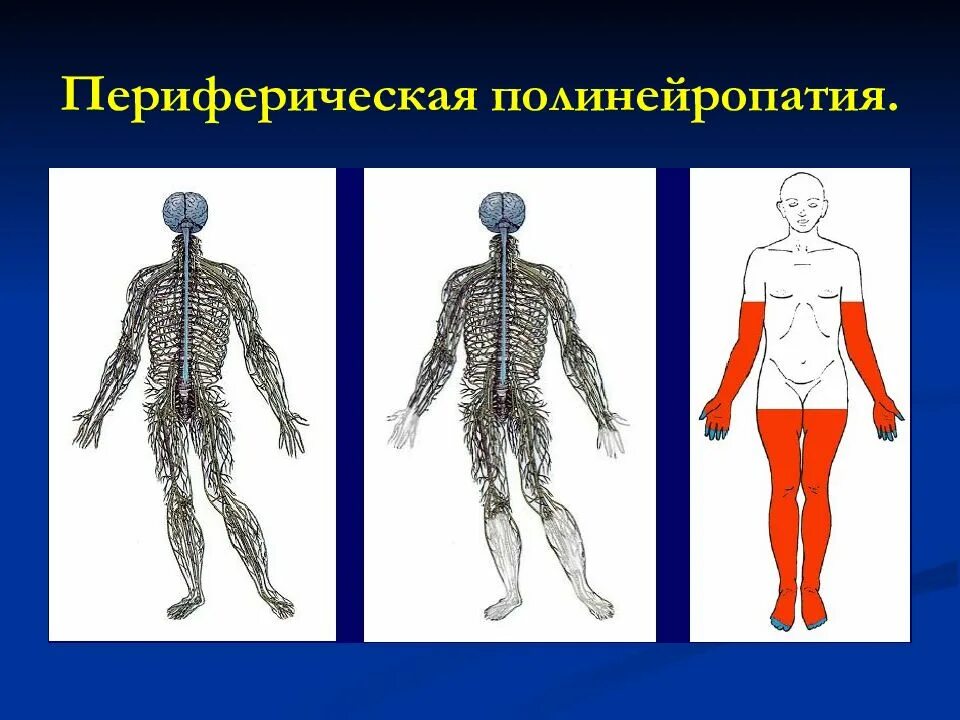 Что такое периферическая нейропатия. Дистальная сенсорная полинейропатия. Периферическая нейропатия. Периферическая нейтропения. Периферическая сенсорная полинейропатия.