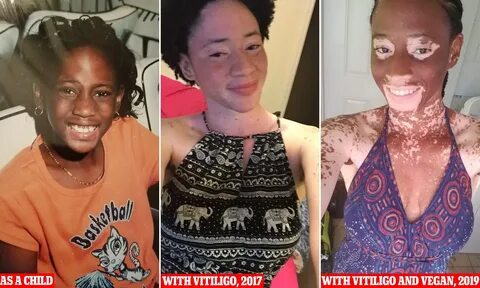 25-Year-Old Vitiligo Sufferer Claims Veganism Helped Her Reverse the.