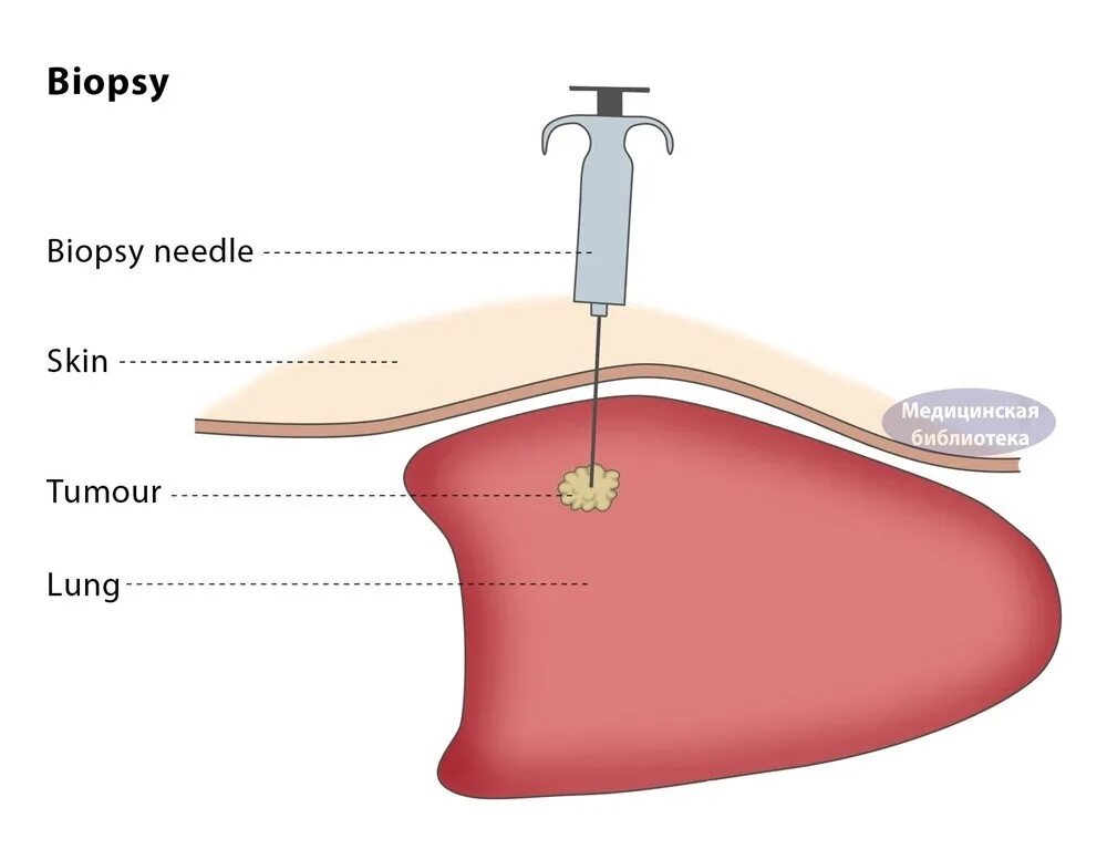 Пункционная биопсия печени. Тонкоигольная аспирационная пункционная биопсия. Пункционная биопсия почек.