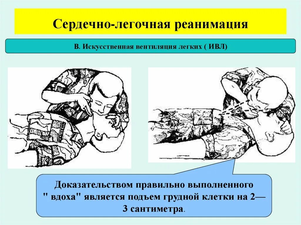 Легочно сердечная реанимация обучение. Сердечно-лёгочная реанимация. Сердечно легочная реанимация ИВЛ. Сердечно легочная реанимация искусственная вентиляция легких. Схема сердечно легочной реанимации.