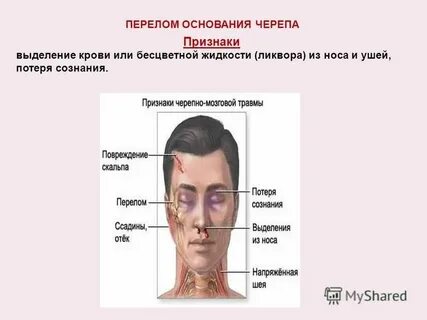 Признаки перелома черепа