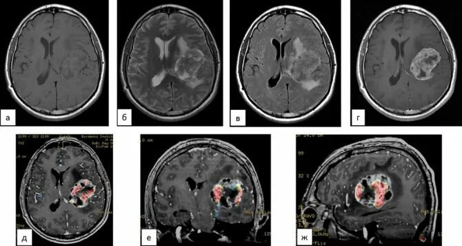Очаги сосудистого генеза головного мозга что это. Глиоз на мрт. Кт перфузия головного мозга. Мрт перфузия мозга. Глиоз головного мозга кт.