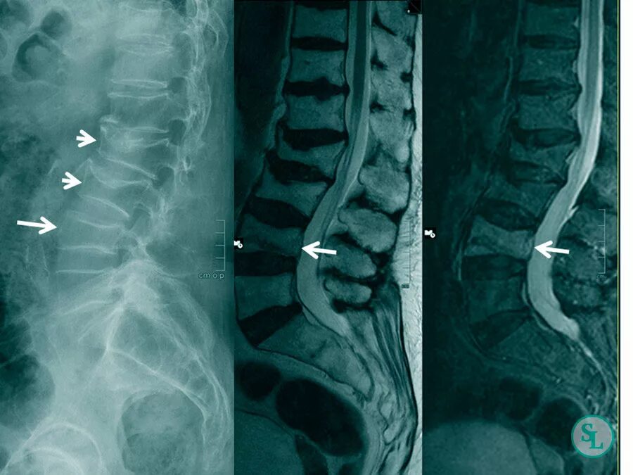 Остеопороз компрессионный перелом позвоночника. Импрессионный перелом позвоночника. Компрессия позвоночника т12 л1. Компрессионный перелом позвоночника тн12.