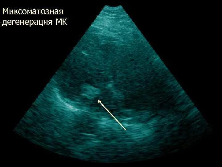 Миксоматозная дегенерация створок клапана. Миксоматозная дегенерация створок митрального клапана. Миксоматоз створок митрального клапана. Миксоматозная дегенерация створок митрального клапана ЭХОКГ.