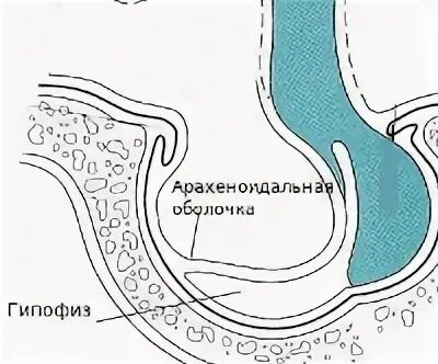 Формирующееся пустое турецкое седло головного. Синдром турецкого седла. Турецкое седло. Пустое турецкое седло на кт. Синдром пустого турецкого седла.