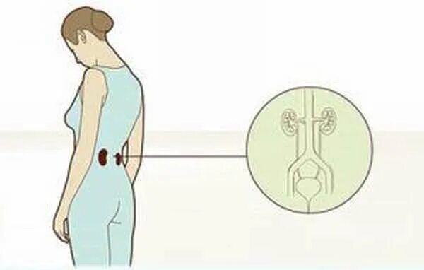 Почки или спина как отличить. Локализация боли в почках.