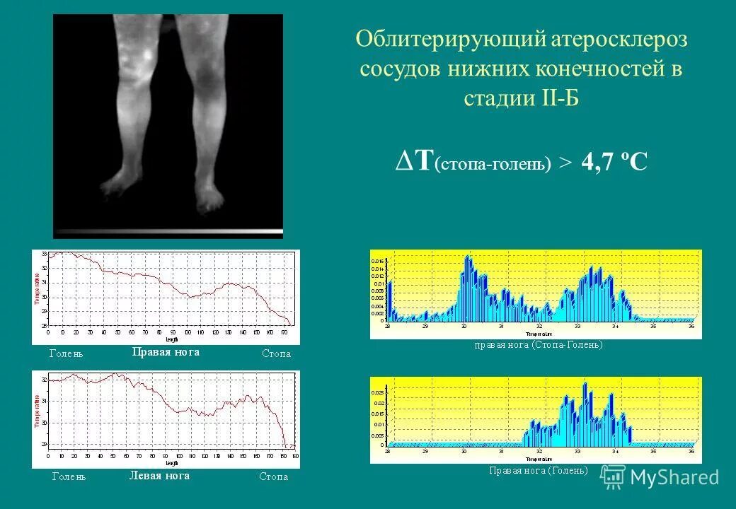 Классификация облитерирующего атеросклероза нижних конечностей. Классификация атеросклероза нижних конечностей. Облитерирующий атеросклероз стадии. Классификация хронической ишемии нижних конечностей по фонтейну. Облитерирующий атеросклероз стадии.