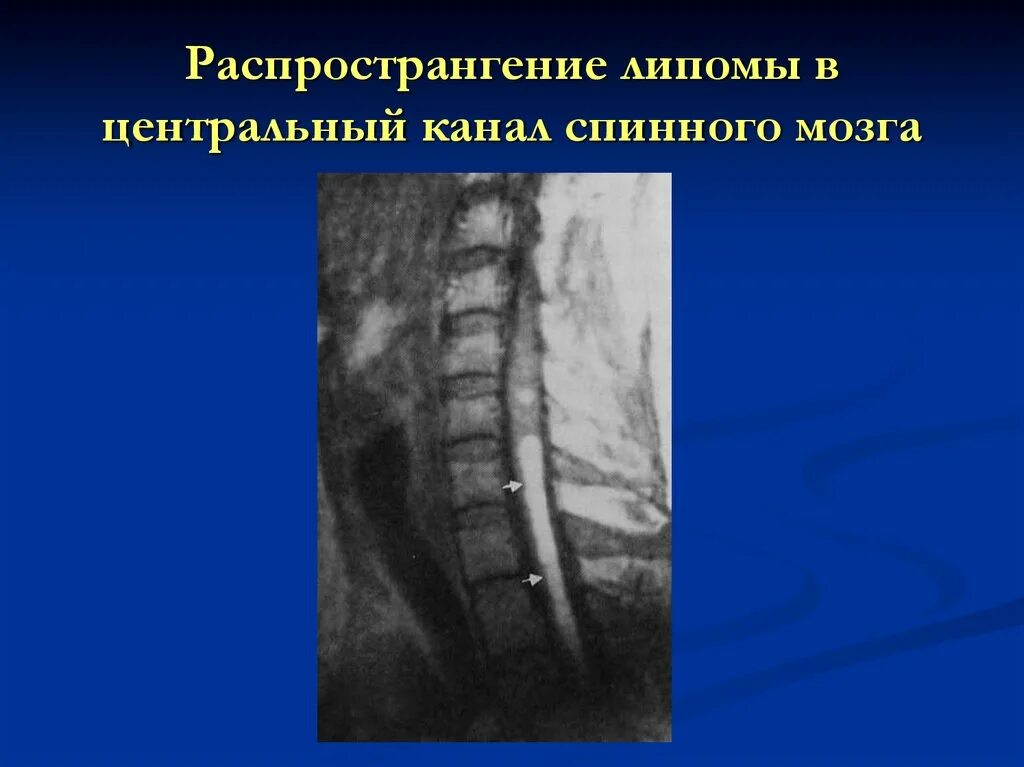 Липома спинного мозга на кт. Липома терминальной нити спинного мозга. Липома спинного мозга мрт. Липома терминальной нити спинного мозга на мрт.