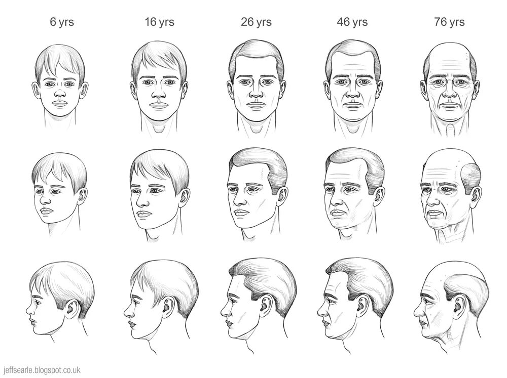Head age. Андрогенетическая алопеция классификация. Head age. Head age. Андерс da 2.
