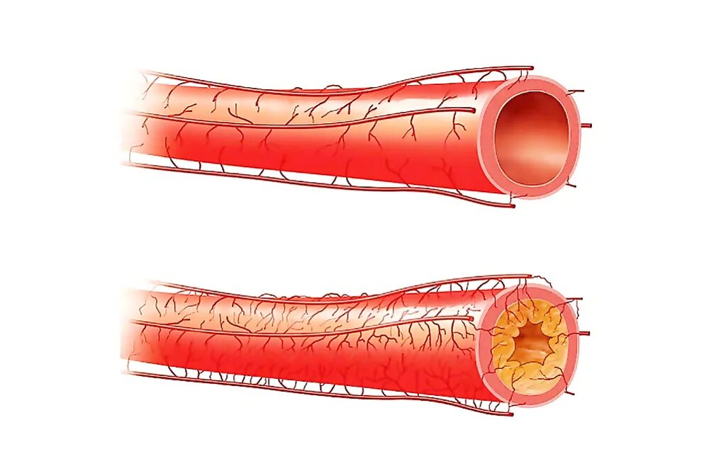 Признаки атеросклеротического поражения артерии. Атеросклеротическое поражение кровеносных сосудов. Атеросклероз коронарных артерий симптомы. Атеросклероз сосудов бца. Атеросклеротическое поражение сердечных артерий.