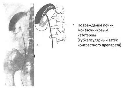 Травма почки