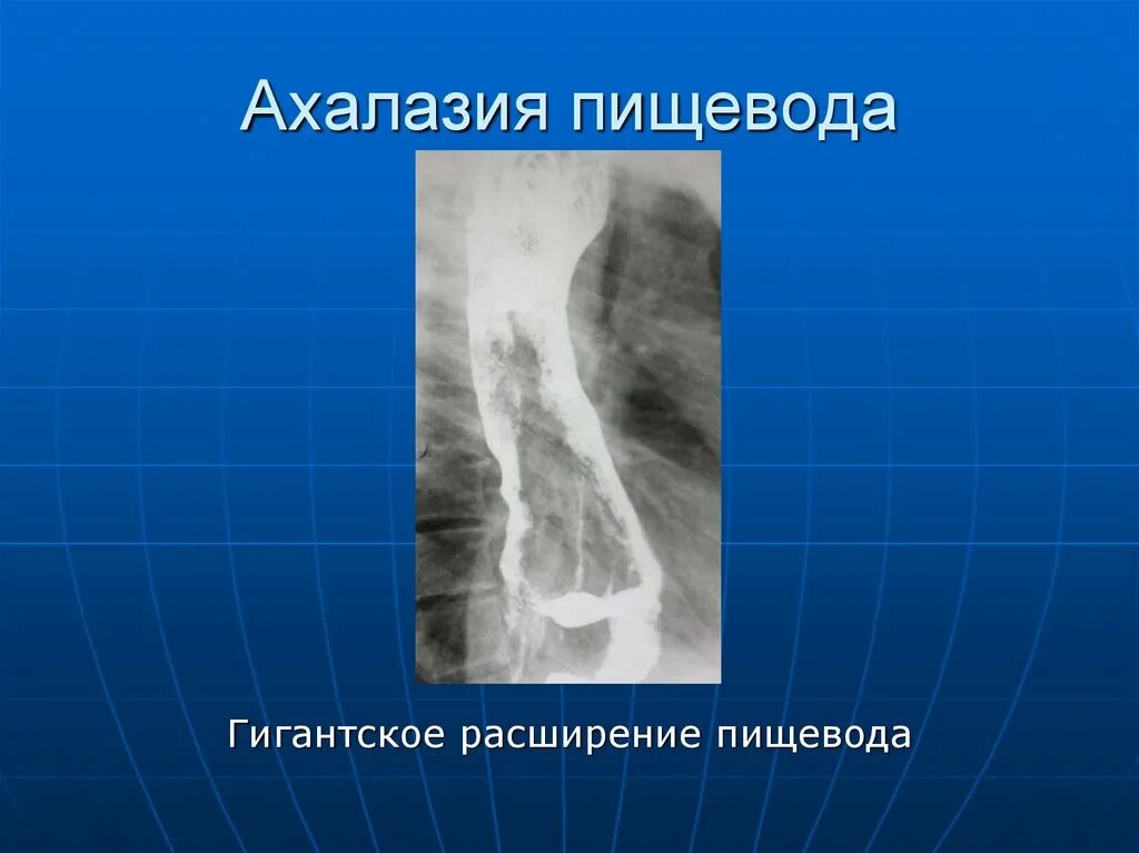 Халазия пищевода. Ахалазия кардии рентген. Расширение пищевода рентген.