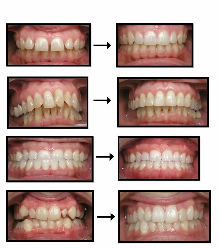 Почему зубы отличаются между собой. Ортодонтические каппы элайнеры. Элайнеры Invisalign. Невидимые брекеты Инвизилайн. Каппы Инвизилайн.