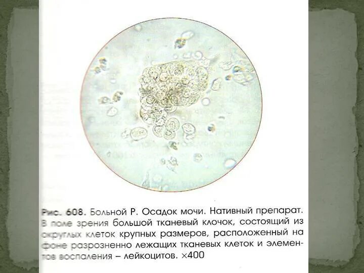 Почему в моче хлопья. Осадок в моче. Белый осадок в моче. Причины белого осадка в моче. Белый хлопьевидный осадок в моче.