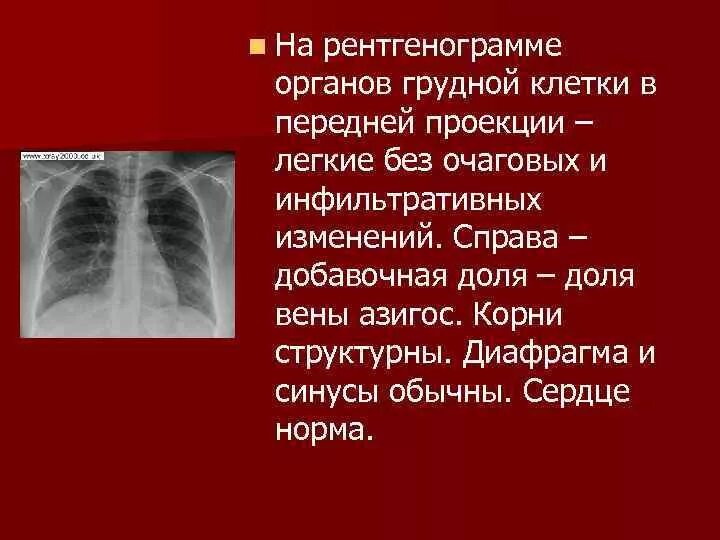 Добавочная Вена азигос. Дополнительная долька непарной вены рентген. Добавочная Вена азигос рентген. Без очаговых и инфильтративных изменений