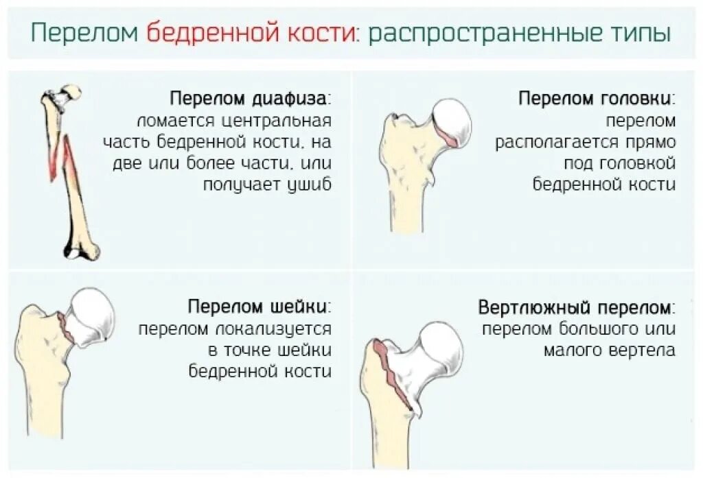 Последствия перелома шейки бедра. Перелом диафиза бедренной кости классификация. Перелом шейки бедра симптомы. При переломе шейки бедренной кости. Переломы шейки бедра классификация.