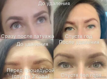Удаление татуажа форум